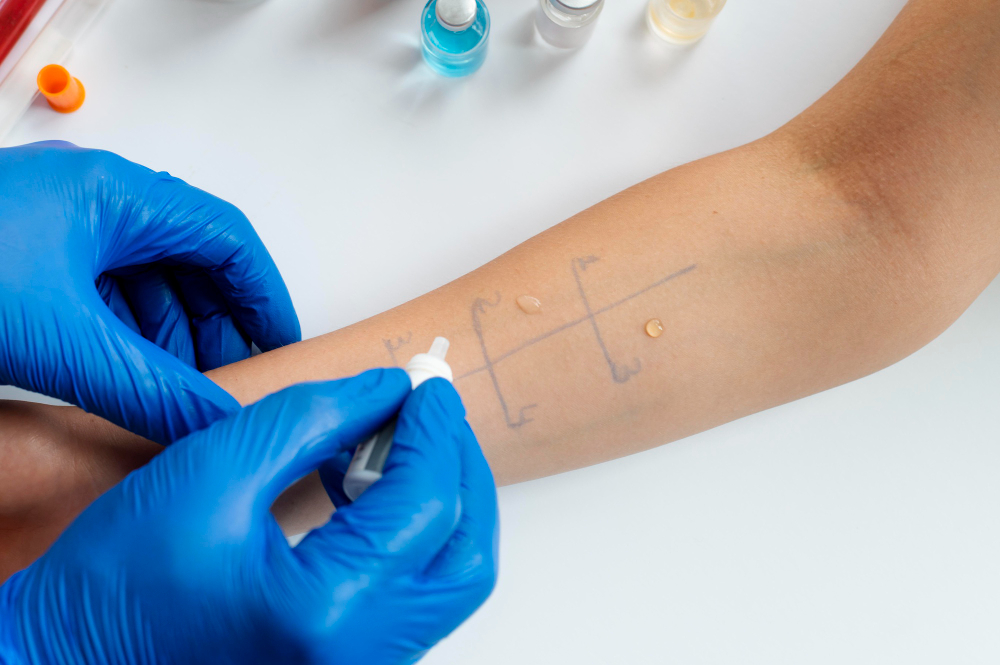 Allergy Testing